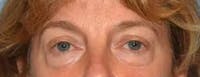 Eyelid Lift Before & After Gallery - Patient 40632010 - Image 1
