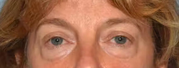 Eyelid Lift Before & After Gallery - Patient 40632010 - Image 1
