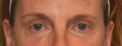 Eyelid Lift Before & After Gallery - Patient 40632010 - Image 2