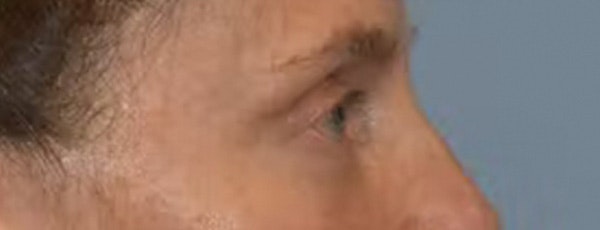 Eyelid Lift Before & After Gallery - Patient 40632010 - Image 6