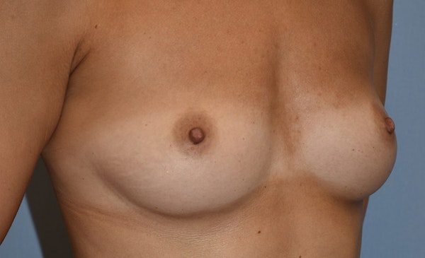 Breast Augmentation Before & After Gallery - Patient 145354205 - Image 3