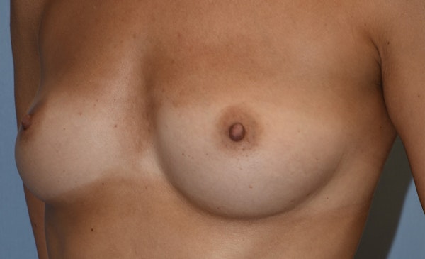 Breast Augmentation Before & After Gallery - Patient 145354205 - Image 5