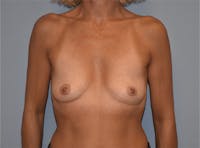 Breast Augmentation Before & After Gallery - Patient 143263771 - Image 1