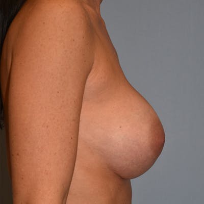Breast Augmentation Before & After Gallery - Patient 122888914 - Image 4