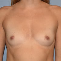 Breast Augmentation Before & After Gallery - Patient 145354318 - Image 1