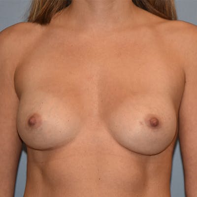 Breast Augmentation Before & After Gallery - Patient 145354318 - Image 2
