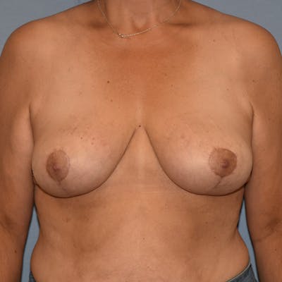 Breast Reduction Before & After Gallery - Patient 145354045 - Image 2