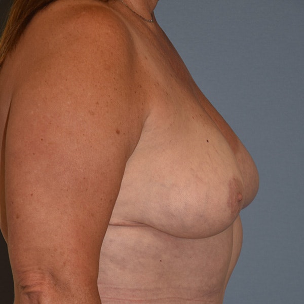 Breast Reduction Before & After Gallery - Patient 92167446 - Image 6