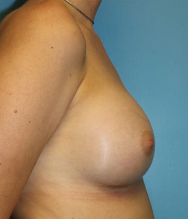Breast Revision Before & After Gallery - Patient 14281712 - Image 6