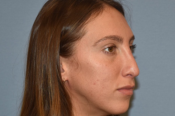 Rhinoplasty Before & After Gallery - Patient 146416162 - Image 6