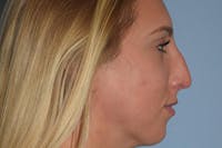 Rhinoplasty Before & After Gallery - Patient 146416162 - Image 1