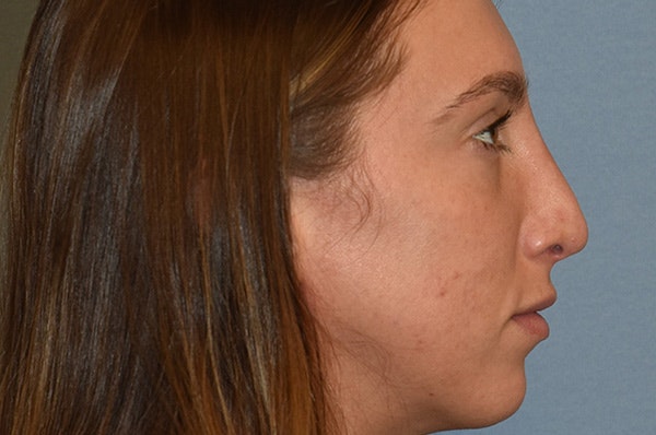 Rhinoplasty Before & After Gallery - Patient 146416162 - Image 2