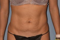 Tummy Tuck Before & After Gallery - Patient 146511332 - Image 1