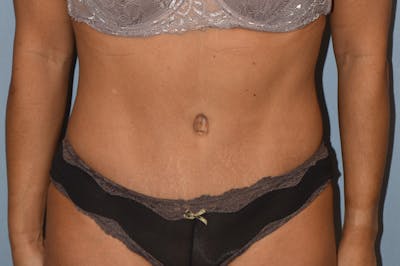 Tummy Tuck Before & After Gallery - Patient 146511332 - Image 2