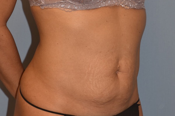 Tummy Tuck Before & After Gallery - Patient 146511332 - Image 3