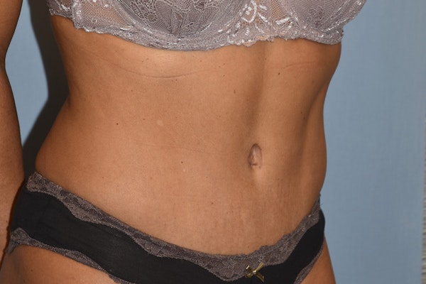 Tummy Tuck Before & After Gallery - Patient 146511332 - Image 4