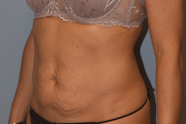 Tummy Tuck Before & After Gallery - Patient 146511332 - Image 5