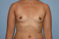 Breast Augmentation Before & After Gallery - Patient 146991104 - Image 1