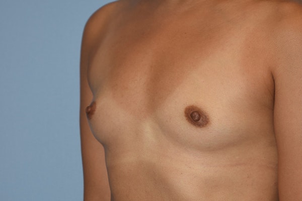 Breast Augmentation Before & After Gallery - Patient 146991104 - Image 5