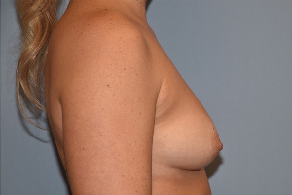 Breast Augmentation  Before & After Gallery - Patient 146991143 - Image 5
