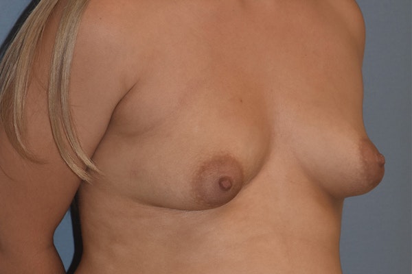 Breast Reduction Before & After Gallery - Patient 146991150 - Image 1