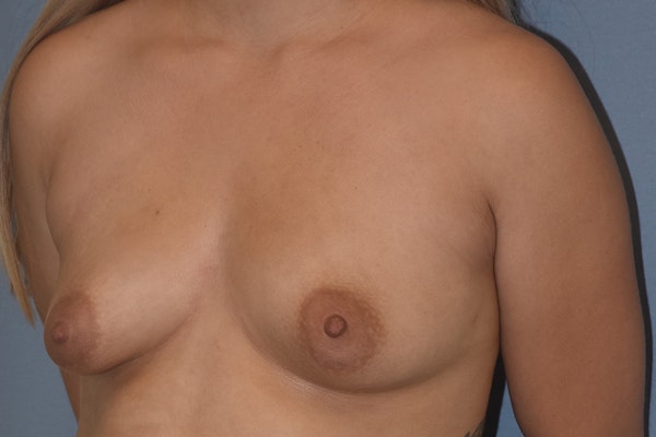 Breast Reduction Before & After Gallery - Patient 146991150 - Image 5