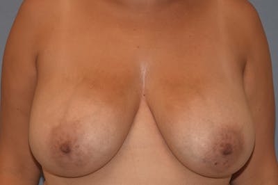 Breast Reduction Before & After Gallery - Patient 146991157 - Image 1