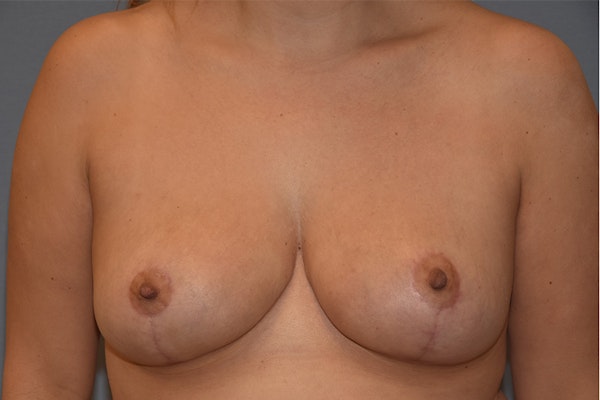 Breast Reduction Before & After Gallery - Patient 146991157 - Image 2