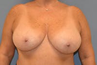 Breast Reduction Before & After Gallery - Patient 147083664 - Image 1