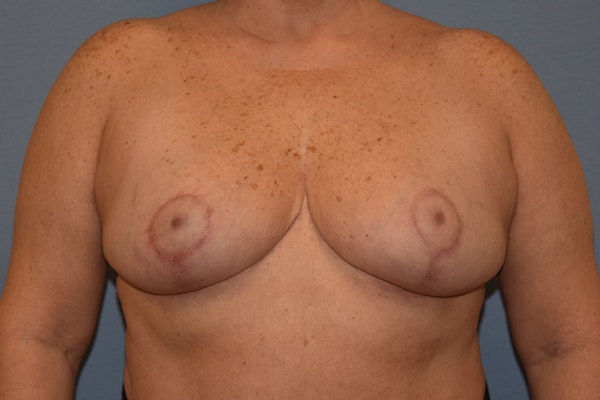 Breast Reduction Before & After Gallery - Patient 147083664 - Image 2