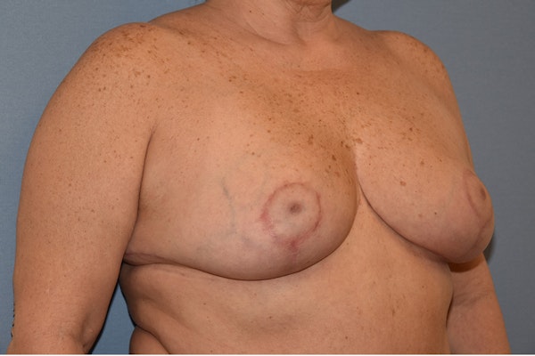 Breast Reduction Before & After Gallery - Patient 147083664 - Image 4