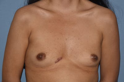 Breast Augmentation Before & After Gallery - Patient 147083683 - Image 1