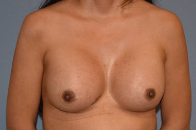 Breast Augmentation Before & After Gallery - Patient 147083683 - Image 2