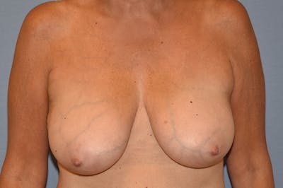 Breast Reduction Before & After Gallery - Patient 147083685 - Image 1