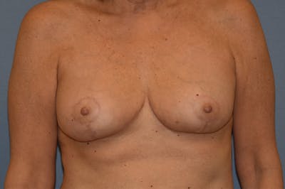 Breast Reduction Before & After Gallery - Patient 147083685 - Image 2