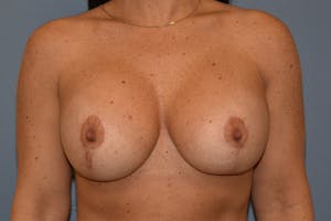 Before and After Long Island Breast Reduction