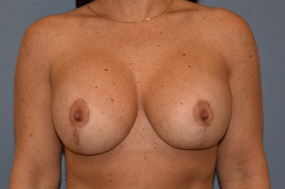 Breast Revision Before & After Gallery - Patient 147083991 - Image 2