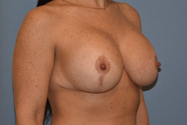 Breast Revision Before & After Gallery - Patient 147083991 - Image 4
