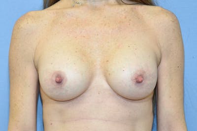 Breast Augmentation  Before & After Gallery - Patient 147084002 - Image 2