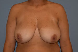 Before and After Long Island Breast Reduction