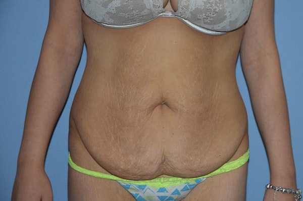 Tummy Tuck Before & After Gallery - Patient 173564943 - Image 1