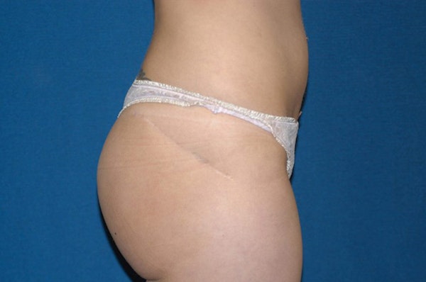 Liposuction Before & After Gallery - Patient 173564941 - Image 4