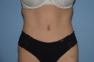 Tummy Tuck Before & After Gallery - Patient 173564943 - Image 2
