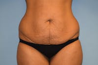 Tummy Tuck Before & After Gallery - Patient 173564953 - Image 1
