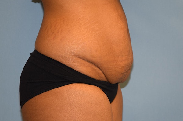 Tummy Tuck Before & After Gallery - Patient 173564953 - Image 5