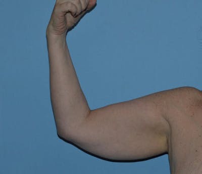 Arm Lift Before & After Gallery - Patient 173564954 - Image 1