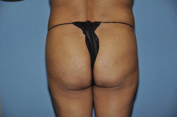 Brazilian Butt Lift Before & After Gallery - Patient 173564971 - Image 1