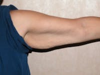 Arm Lift Before & After Gallery - Patient 173564973 - Image 1