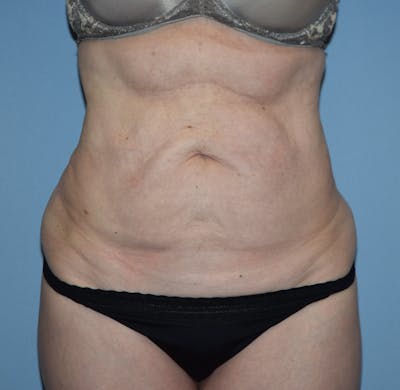 Tummy Tuck Before & After Gallery - Patient 173564984 - Image 1
