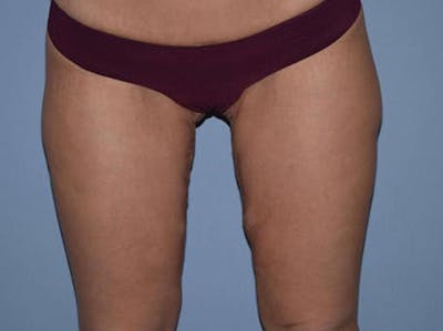 Thigh Lift Before & After Gallery - Patient 173564968 - Image 2